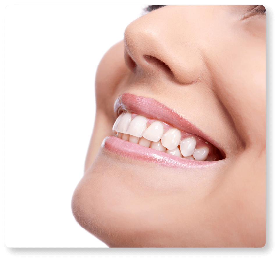 Composite Bonding
